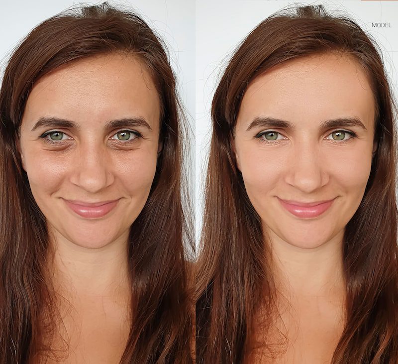How to reduce undereye bags and where do they come from  The Independent   The Independent